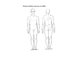 Pontos Gatilho comuns na SDM
 