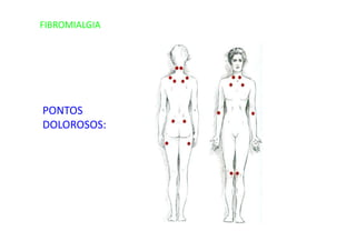 FIBROMIALGIA
PONTOS
DOLOROSOS:
 