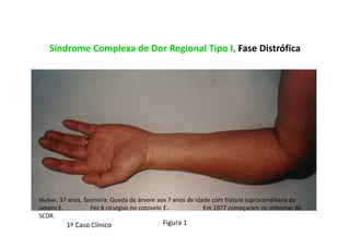 Síndrome Complexa de Dor Regional Tipo I, Fase Distrófica
Figura 1
Mulher, 37 anos, faxineira. Queda de árvore aos 7 anos de idade com fratura supracondiliana do
úmero E. Fez 6 cirurgias no cotovelo E.. Em 1977 começaram os sintomas de
SCDR.
1º Caso Clínico
 