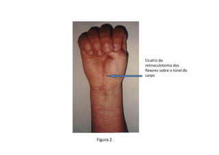 Figura 2
Cicatriz da
retinaculotomia dos
flexores sobre o túnel do
carpo
 