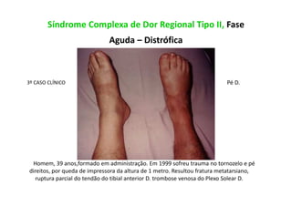 Síndrome Complexa de Dor Regional Tipo II, Fase
Aguda – Distrófica
3º CASO CLÍNICO
Homem, 39 anos,formado em administração. Em 1999 sofreu trauma no tornozelo e pé
direitos, por queda de impressora da altura de 1 metro. Resultou fratura metatarsiano,
ruptura parcial do tendão do tibial anterior D. trombose venosa do Plexo Solear D.
Pé D.
 