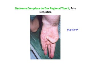 Síndrome Complexa de Dor Regional Tipo II, Fase
Distrófica
Dupuytren
 