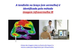 A tendinite no braço (em vermelho) é
identificada pelo método
imagem infravermelha IR
A base das imagens vistas na Guerra do Iraque é a
mesma usada para diagnóstico por infravermelho.
 