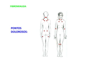 FIBROMIALGIA
PONTOS
DOLOROSOS:
 