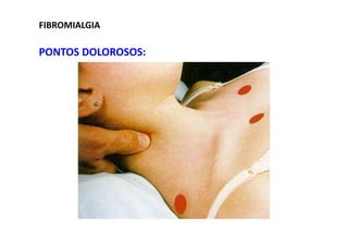 FIBROMIALGIA
PONTOS DOLOROSOS:
 