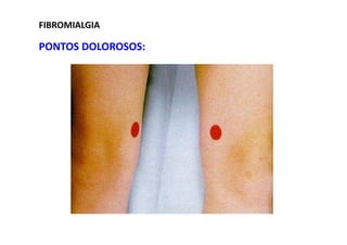 FIBROMIALGIA
PONTOS DOLOROSOS:
 