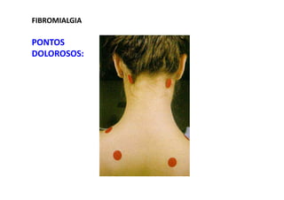 FIBROMIALGIA
PONTOS
DOLOROSOS:
 