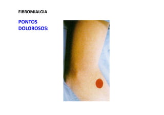 FIBROMIALGIA
PONTOS
DOLOROSOS:
 
