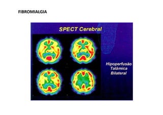 FIBROMIALGIAFIBROMIALGIA
 