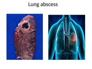 Lung abscess
 
