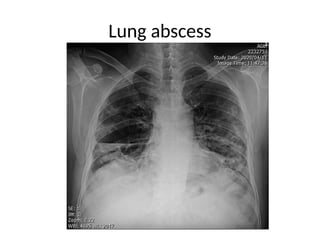 Lung abscess
 