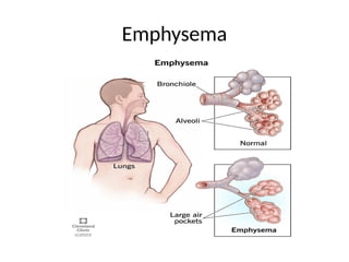 Emphysema
 