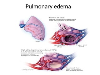 Pulmonary edema
 