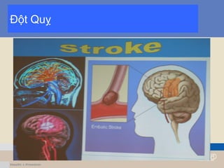 Đột Quỵ
 