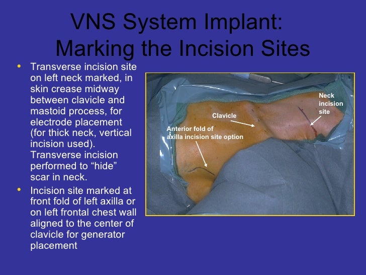 Vns Therapy™ System For Weikong For Print