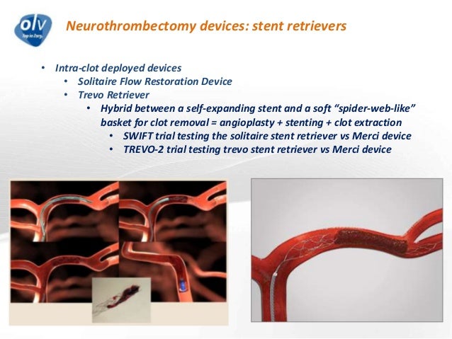 Solitaire Device Thrombectomy – Solitaire X Device – PZWK