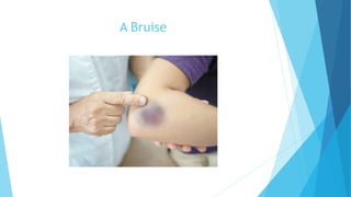 A Bruise
 