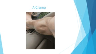 A Cramp
 