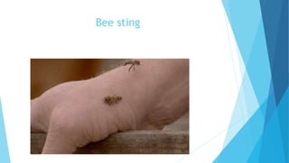 Bee sting
 