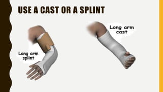 USE A CAST OR A SPLINT
 