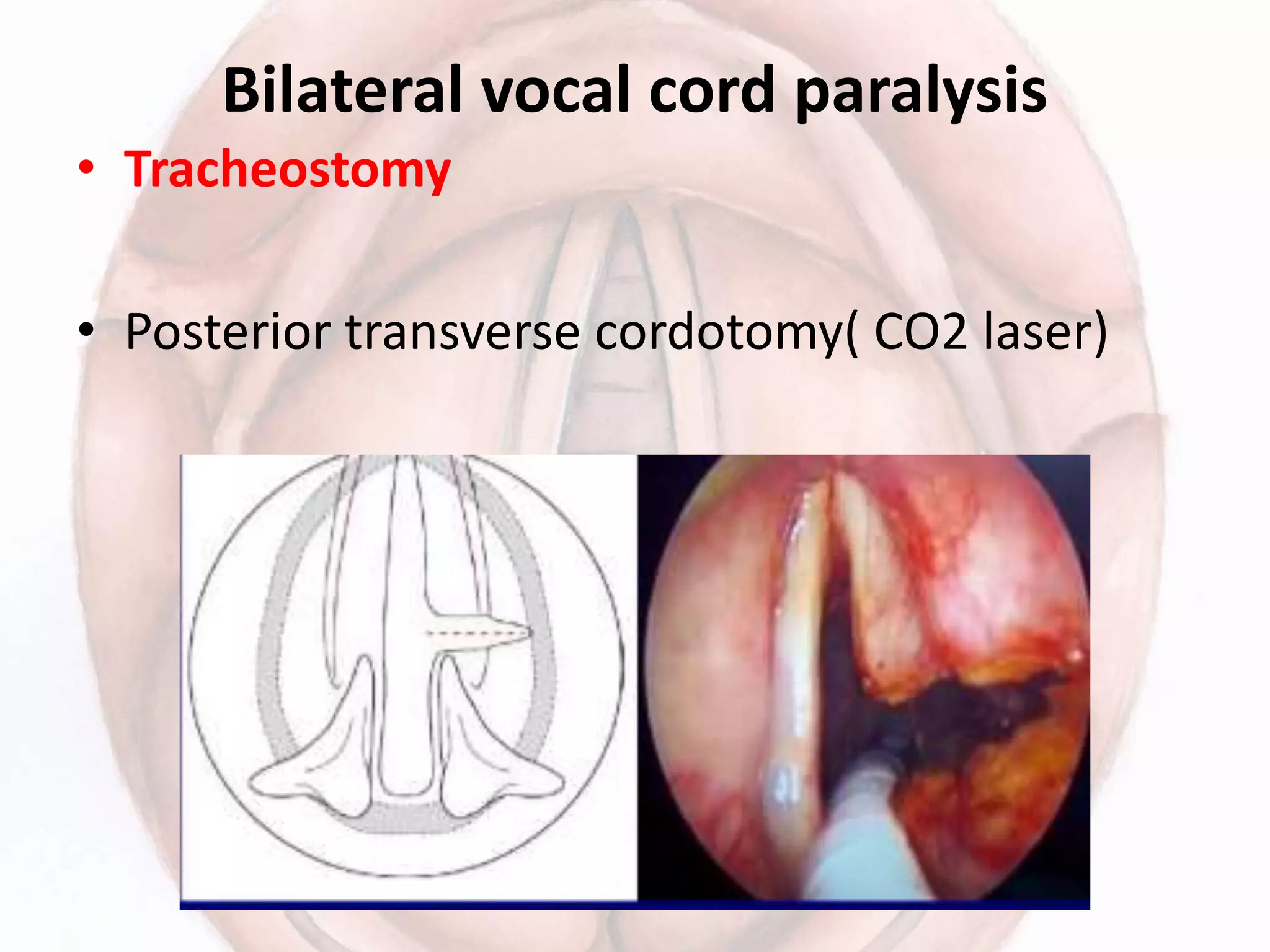 Bilateral vocal cord paralysis
• Tracheostomy
• Posterior transverse cordotomy( CO2 laser)
 