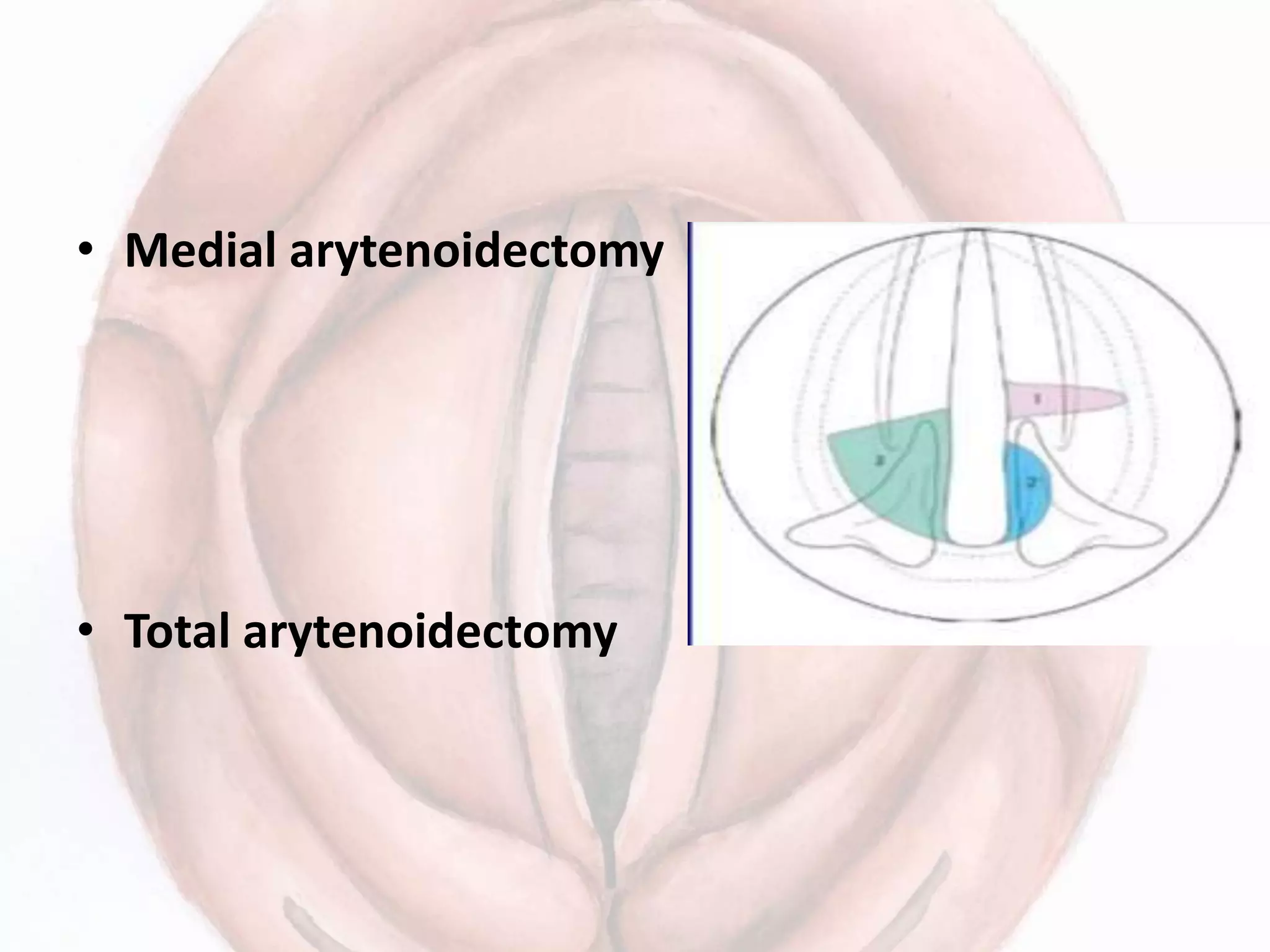 • Medial arytenoidectomy
• Total arytenoidectomy
 