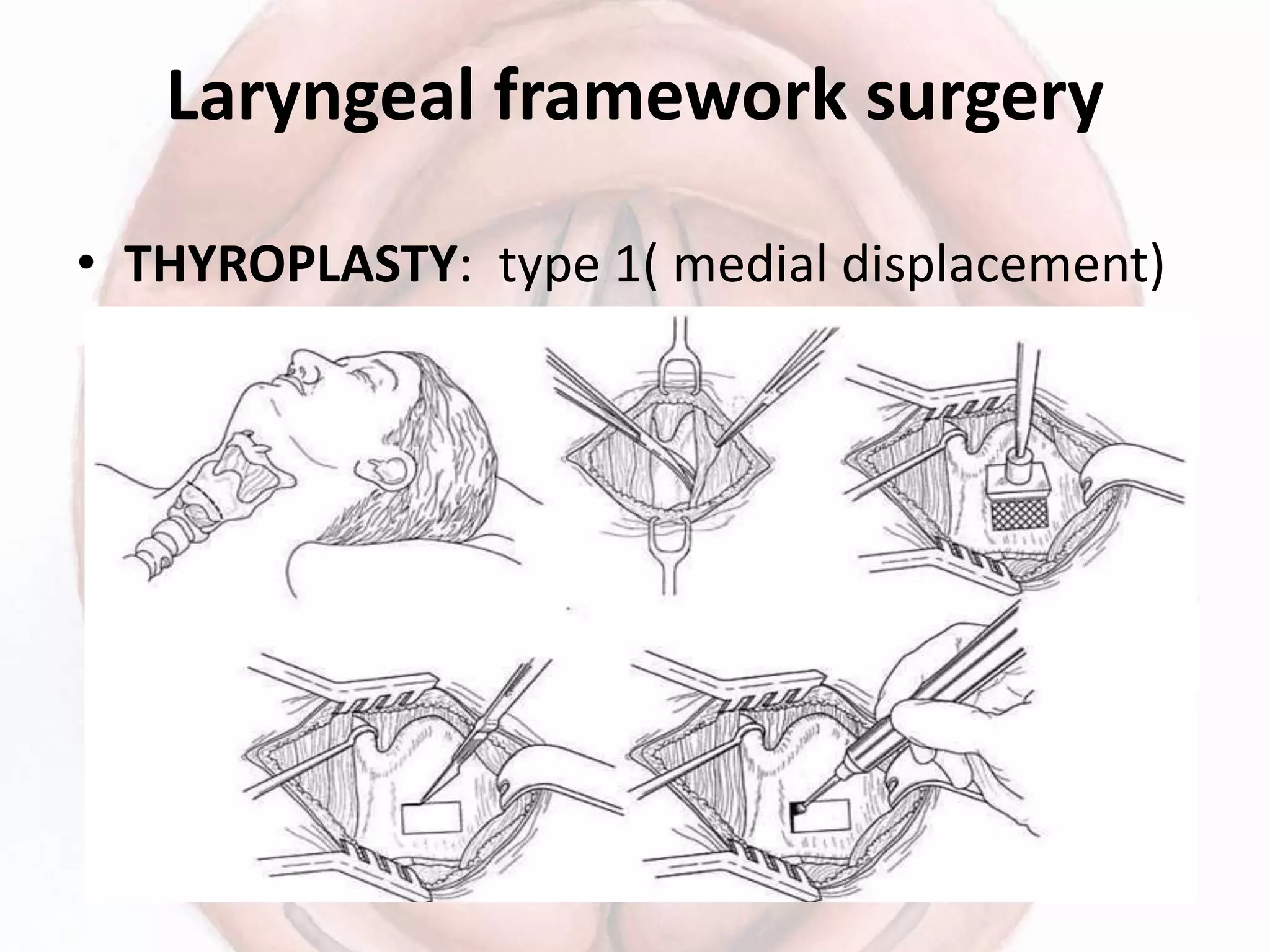 Laryngeal framework surgery
• THYROPLASTY: type 1( medial displacement)
 