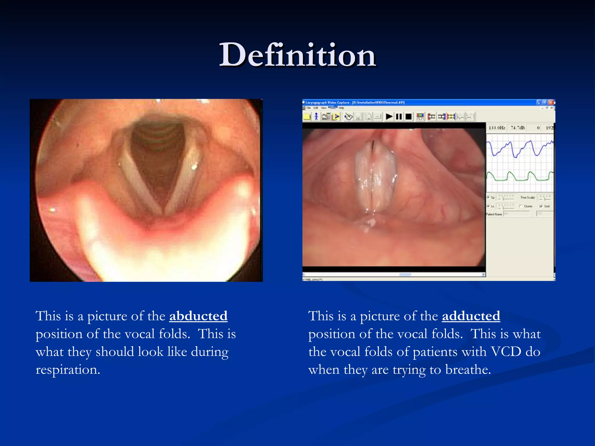 Definition This is a picture of the  abducted  position of the vocal folds.  This is what they should look like during respiration. This is a picture of the  adducted  position of the vocal folds.  This is what the vocal folds of patients with VCD do when they are trying to breathe. 