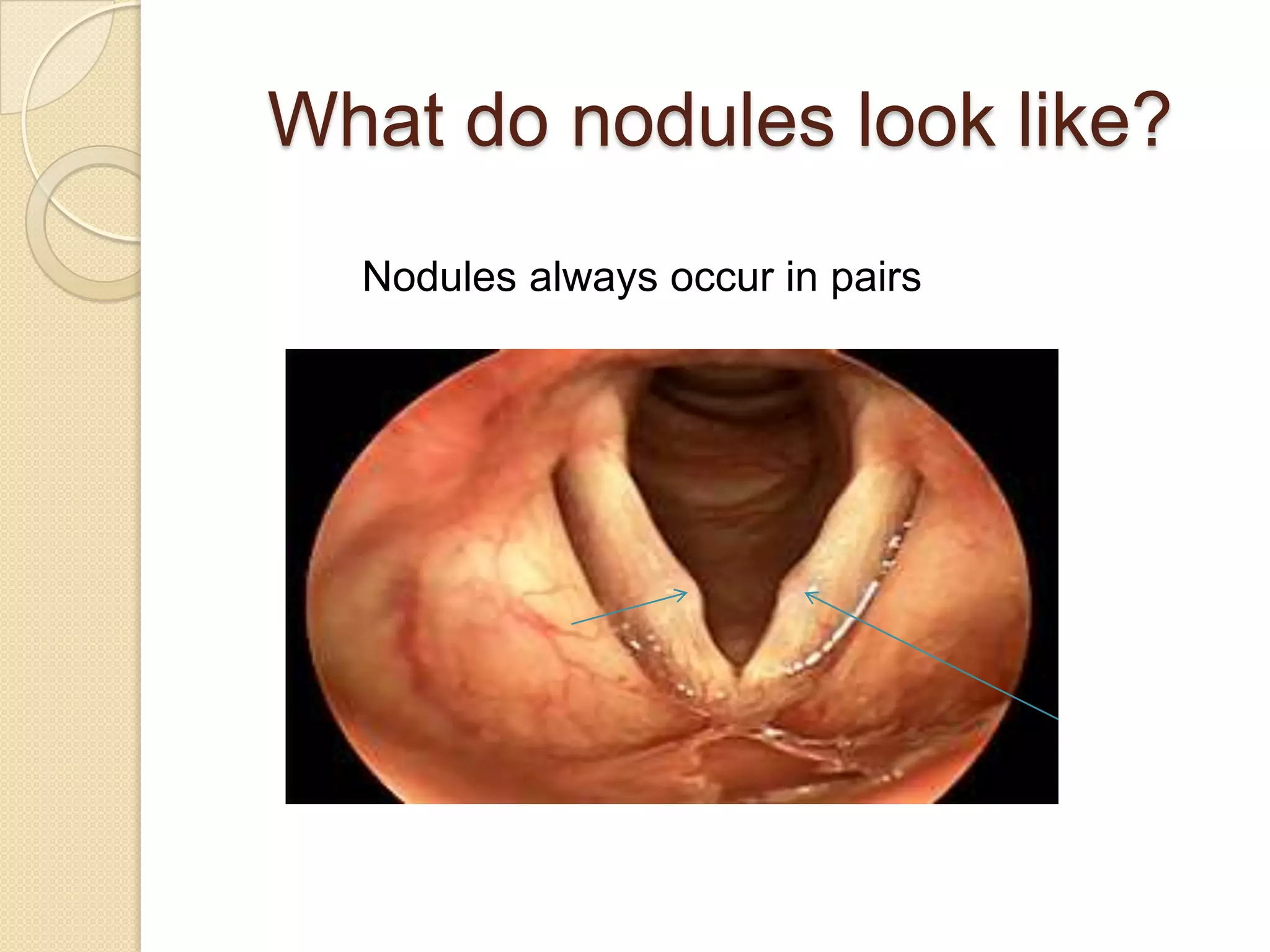 What do nodules look like?
  Nodules always occur in pairs
 