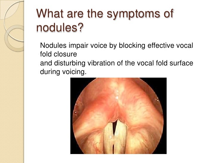Vocal cord nodule