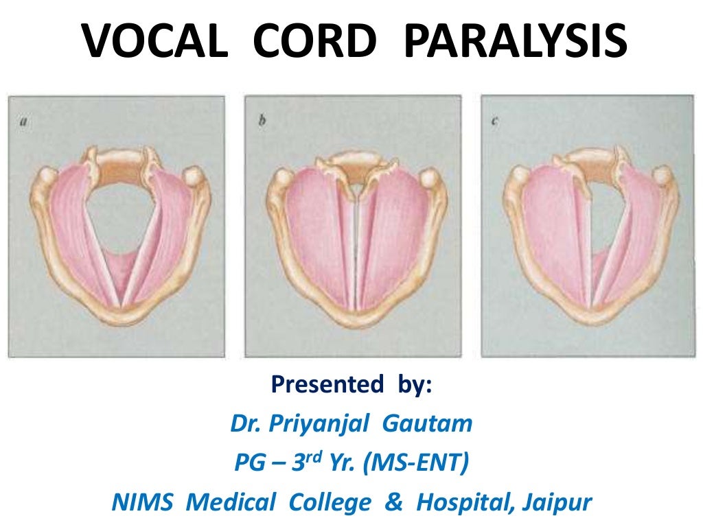 Vocal cord paralysis