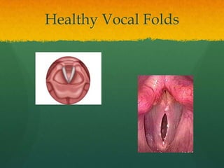 Healthy Vocal Folds