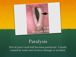 Paralysis Part of your vocal fold becomes paralyzed. Usually caused by some sort of nerve damage or accident.