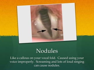 NodulesLike a callous on your vocal fold. Caused using your voice improperly. Screaming and lots of loud singing can cause nodules.