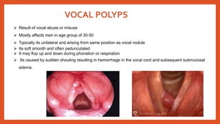 VOCAL POLYPS
 Result of vocal abuse or misuse
 Mostly affects men in age group of 30-50
 Typically its unilateral and arising from same position as vocal nodule
 Its soft smooth and often pedunculated
 It may flop up and down during phonation or respiration
 Its caused by sudden shouting resulting in hemorrhage in the vocal cord and subsequent submucosal
edema.
 