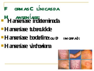 Formas Clínicas da Hanseníase:  Hanseníase indeterminada :  Hanseníase tuberculóide   Hanseníase borderline  (ou Dimorfa):  Hanseníase virchowiana   