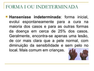 FORMA I OU INDETERMINADA Hanseníase indeterminada : forma inicial, evolui espontaneamente para a cura na maioria dos casos e para as outras formas da doença em cerca de 25% dos casos. Geralmente, encontra-se apenas uma lesão, de cor mais clara que a pele normal, com diminuição da sensibilidade e sem pelo no local. Mais comum em crianças.  