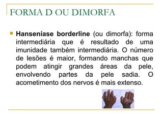 FORMA D OU DIMORFA Hanseníase borderline  (ou dimorfa): forma intermediária que é resultado de uma imunidade também intermediária. O número de lesões é maior, formando manchas que podem atingir grandes áreas da pele, envolvendo partes da pele sadia. O acometimento dos nervos é mais extenso.  