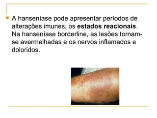 A hanseníase pode apresentar períodos de alterações imunes, os  estados reacionais . Na hanseníase borderline, as lesões tornam-se avermelhadas e os nervos inflamados e doloridos.  