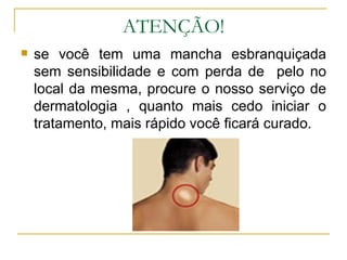 ATENÇÃO! se você tem uma mancha esbranquiçada sem sensibilidade e com perda de  pelo no local da mesma, procure o nosso serviço de dermatologia , quanto mais cedo iniciar o tratamento, mais rápido você ficará curado. 