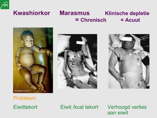 Kwashiorkor   Marasmus   Klinische depletie      =  Chronisch  = Acuut Probleem: Eiwittekort Eiwit /kcal tekort Verhoogd verlies  aan eiwit  
