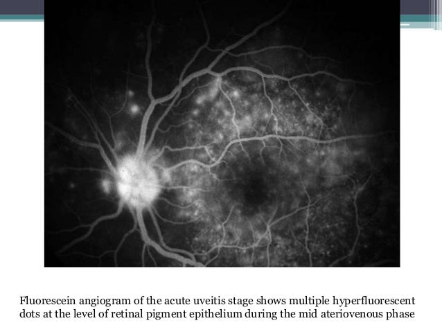 Vogt Koyanagi Harada Disease