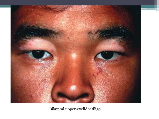 Vogt Koyanagi Harada Disease
