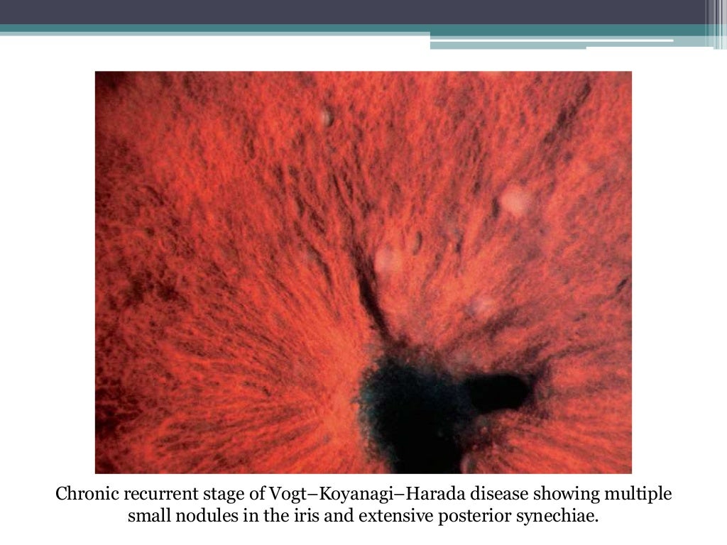 Vogt Koyanagi Harada Disease