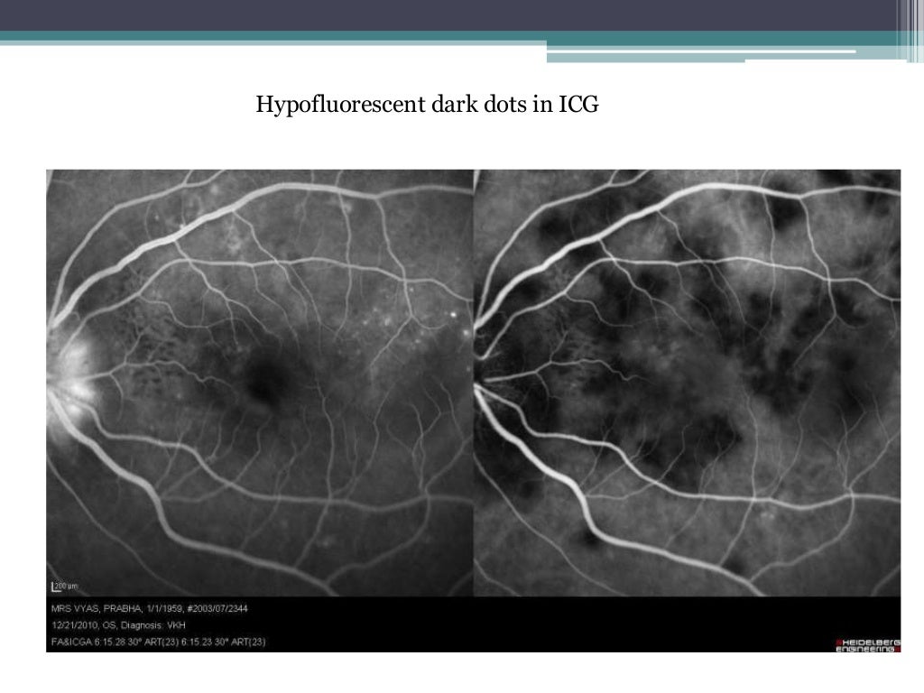 Vogt Koyanagi Harada Disease