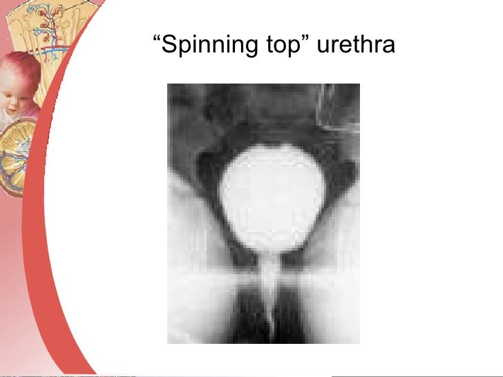 Voiding Disorders In Children