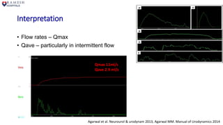 Interpretation
• Flow rates – Qmax
• Qave – particularly in intermittent flow
Agarwal et al. Neurourol & urodynam 2013, Agarwal MM. Manual of Urodynamics 2014
Qmax 11ml/s
Qave 2.9 ml/s
 