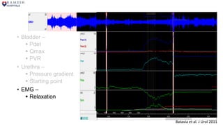 • Bladder –
 Pdet
 Qmax
 PVR
• Urethra –
 Pressure gradient
 Starting point
• EMG –
 Relaxation
Batavia et al. J Urol 2011
 