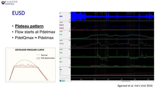 EUSD
• Plateau pattern
• Flow starts at Pdetmax
• PdetQmax ≈ Pdetmax
Agarwal et al. Ind J Urol 2016
 