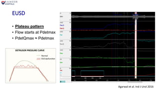 EUSD
• Plateau pattern
• Flow starts at Pdetmax
• PdetQmax ≈ Pdetmax
Agarwal et al. Ind J Urol 2016
 